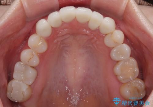気にしていた歯並びをインビザラインで改善　セラミックも作り替えて綺麗な口元にの治療後