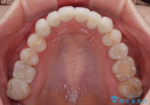 気にしていた歯並びをインビザラインで改善 セラミックも作り替えて綺麗な口元にの治療後