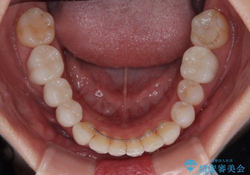 気にしていた歯並びをインビザラインで改善 セラミックも作り替えて綺麗な口元にの治療後