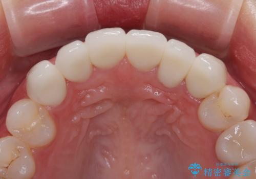 気にしていた歯並びをインビザラインで改善 セラミックも作り替えて綺麗な口元にの治療後