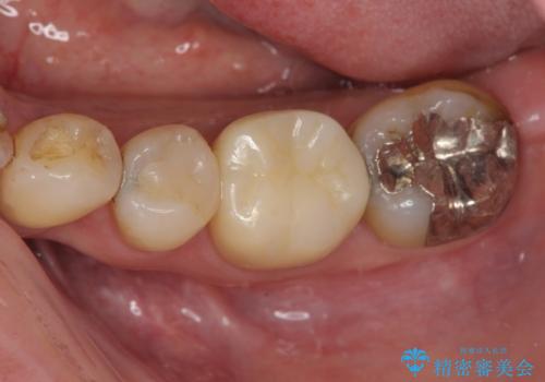 金属の詰め物が取れた オールセラミッククラウンの治療後