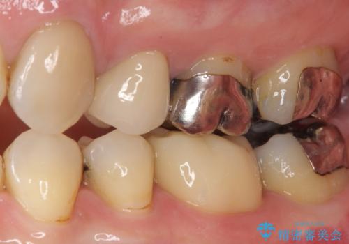 金属の詰め物が取れた オールセラミッククラウンの治療後