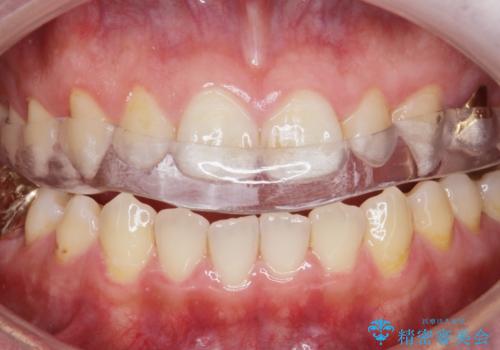 ナイトガードによる歯の予防。の症例 治療後