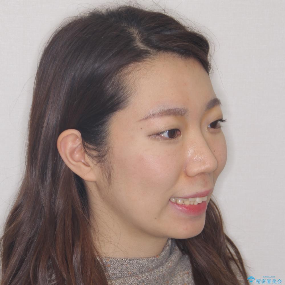 【モニター】飛び出した上顎前歯を抜歯矯正で引っ込める ワイヤー装置の抜歯矯正治療の治療前(顔貌)