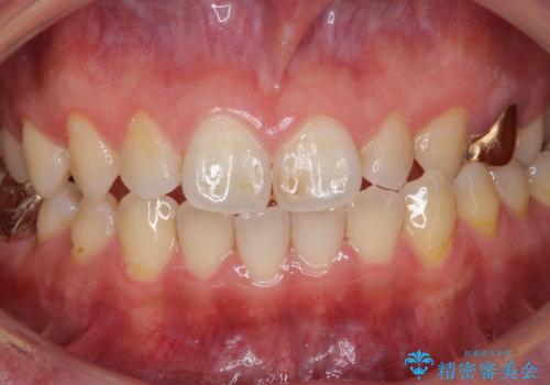 ナイトガードによる歯の予防。の症例 治療前