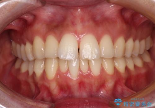 【モニター】飛び出した上顎前歯を抜歯矯正で引っ込める ワイヤー装置の抜歯矯正治療の治療前