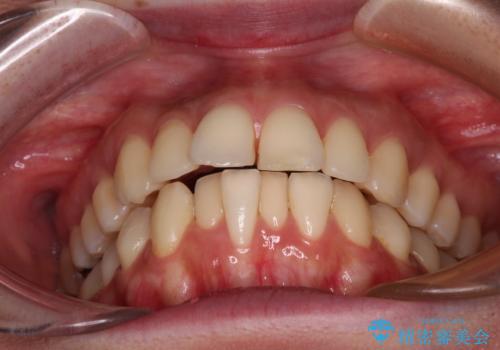 【モニター】飛び出した上顎前歯を抜歯矯正で引っ込める ワイヤー装置の抜歯矯正治療の治療前