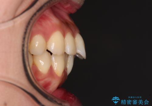 【モニター】飛び出した上顎前歯を抜歯矯正で引っ込める ワイヤー装置の抜歯矯正治療の治療前