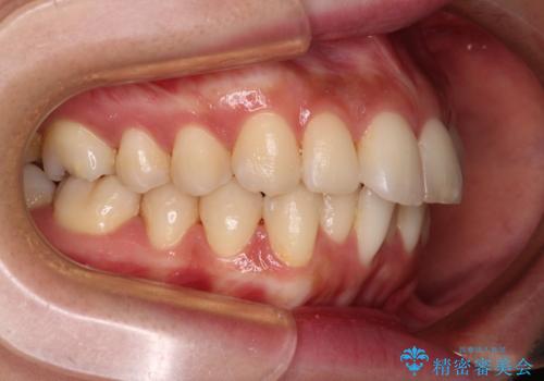 【モニター】飛び出した上顎前歯を抜歯矯正で引っ込める ワイヤー装置の抜歯矯正治療の治療前