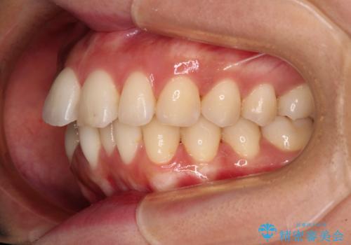 【モニター】飛び出した上顎前歯を抜歯矯正で引っ込める ワイヤー装置の抜歯矯正治療の治療前