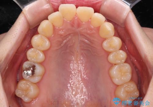 【モニター】飛び出した上顎前歯を抜歯矯正で引っ込める ワイヤー装置の抜歯矯正治療の治療前