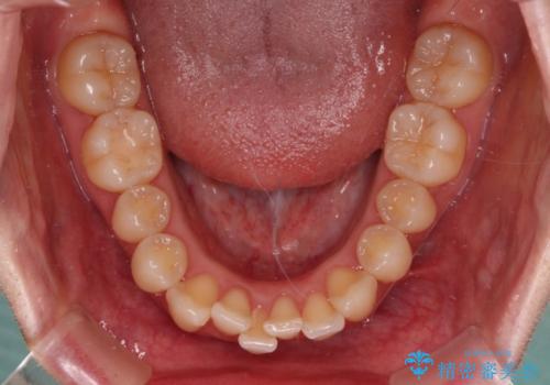 【モニター】飛び出した上顎前歯を抜歯矯正で引っ込める ワイヤー装置の抜歯矯正治療の治療前