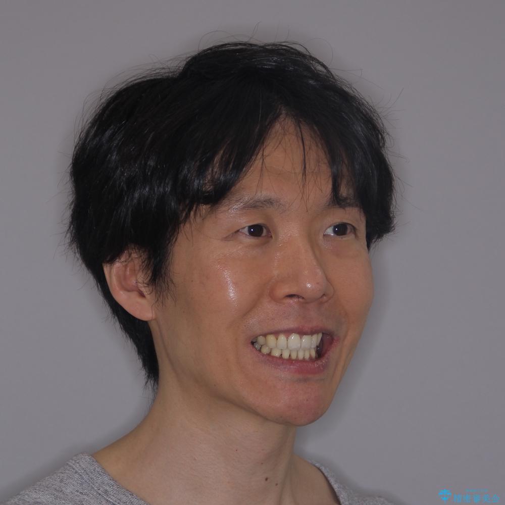 【モニター】口が閉じにくい 抜歯矯正でスッキリした口元にの治療後(顔貌)