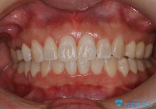 【審美装置】上下の前歯をきれいにしたい