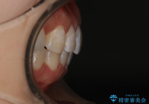 【審美装置】上下の前歯をきれいにしたい の治療後
