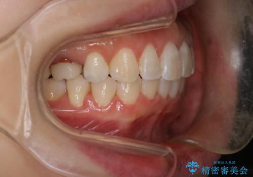 【審美装置】上下の前歯をきれいにしたい の治療後