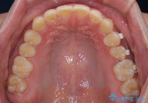 ねじれの強い前歯と奥歯　インビザラインでの矯正治療の治療中