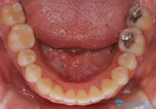 【審美装置】上下の前歯をきれいにしたい の治療後