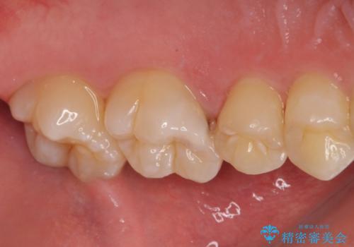 歯に穴が開いた セラミックインレー修復の治療前