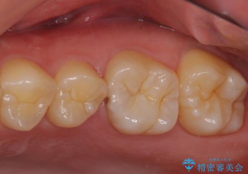 歯に穴が開いた　セラミックインレー修復の治療前