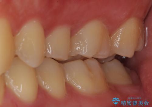 歯に穴が開いた セラミックインレー修復の治療前