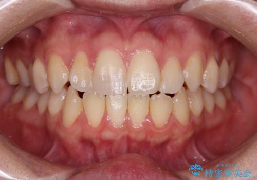 違和感のある前歯をセラミックにしたいの症例 治療前