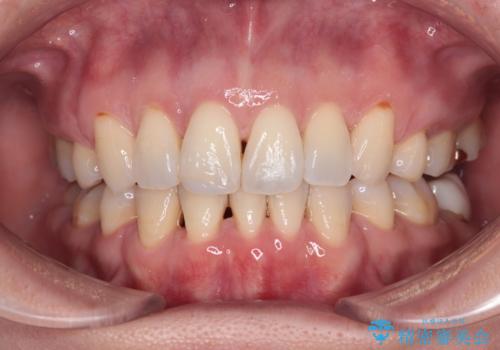 前方に飛び出した前歯 ワイヤー装置での抜歯矯正の症例 治療後
