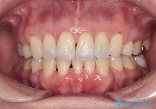 前方に飛び出した前歯　ワイヤー装置での抜歯矯正