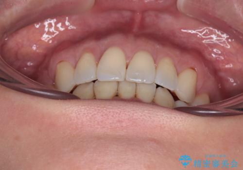 前方に飛び出した前歯 ワイヤー装置での抜歯矯正の治療後