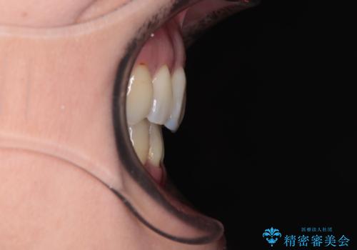 前方に飛び出した前歯 ワイヤー装置での抜歯矯正の治療後