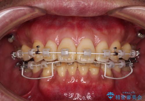 【モニター】口が閉じにくい 抜歯矯正でスッキリした口元にの治療中