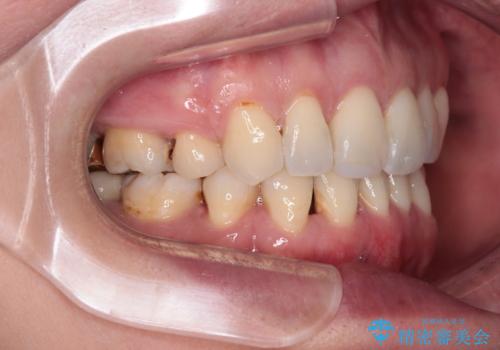 前方に飛び出した前歯 ワイヤー装置での抜歯矯正の治療後