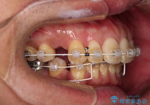 【モニター】口が閉じにくい　抜歯矯正でスッキリした口元にの治療中