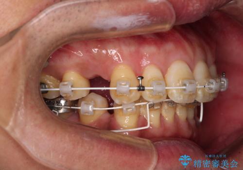 【モニター】口が閉じにくい 抜歯矯正でスッキリした口元にの治療中