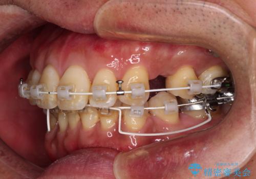 【モニター】口が閉じにくい　抜歯矯正でスッキリした口元にの治療中