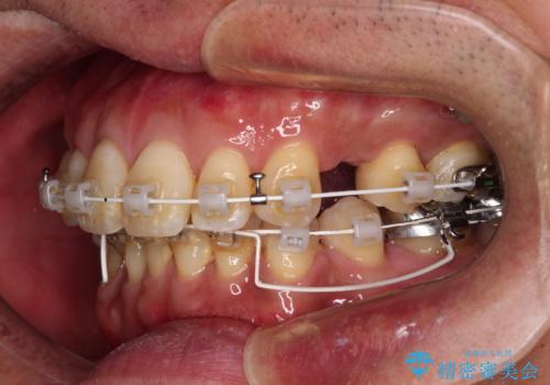【モニター】口が閉じにくい 抜歯矯正でスッキリした口元にの治療中