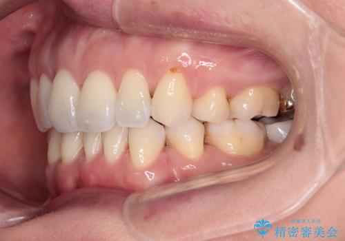 前方に飛び出した前歯 ワイヤー装置での抜歯矯正の治療後