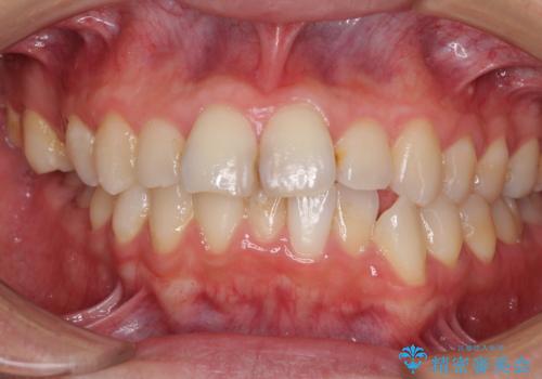 顎が左右にずれた咬み合わせ ハーフリンガルの抜歯矯正の治療前