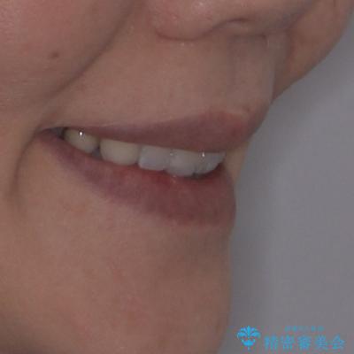 前方に飛び出した前歯 ワイヤー装置での抜歯矯正の治療後(顔貌)