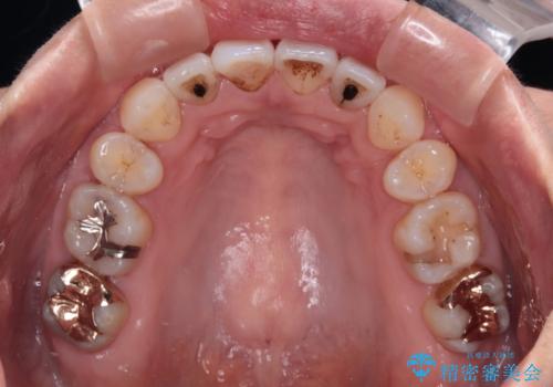 前方に飛び出した前歯 ワイヤー装置での抜歯矯正の治療後