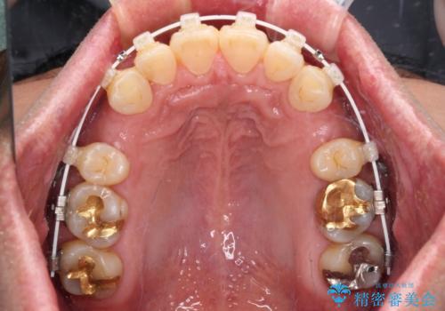 【モニター】口が閉じにくい 抜歯矯正でスッキリした口元にの治療中
