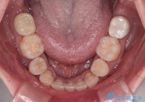 前方に飛び出した前歯　ワイヤー装置での抜歯矯正の治療後