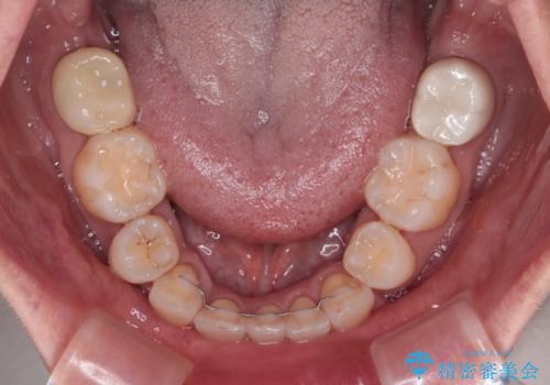 前方に飛び出した前歯 ワイヤー装置での抜歯矯正の治療後