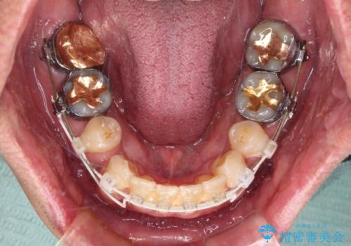 【モニター】口が閉じにくい 抜歯矯正でスッキリした口元にの治療中