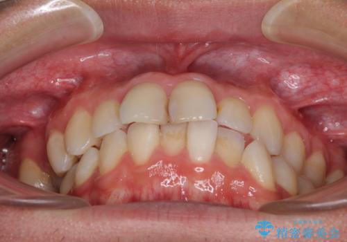 顎が左右にずれた咬み合わせ ハーフリンガルの抜歯矯正の治療前
