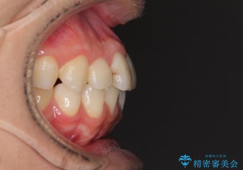 顎が左右にずれた咬み合わせ ハーフリンガルの抜歯矯正の治療前