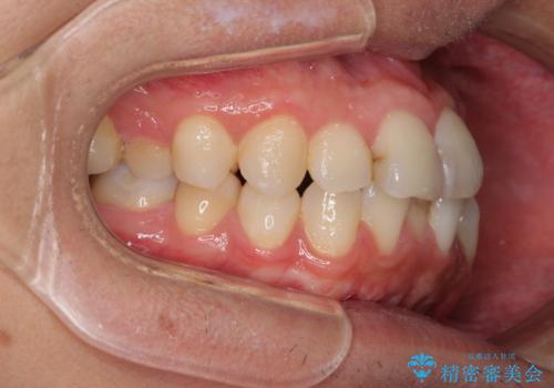 顎が左右にずれた咬み合わせ ハーフリンガルの抜歯矯正の治療前