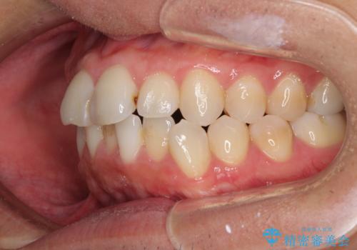 顎が左右にずれた咬み合わせ ハーフリンガルの抜歯矯正の治療前