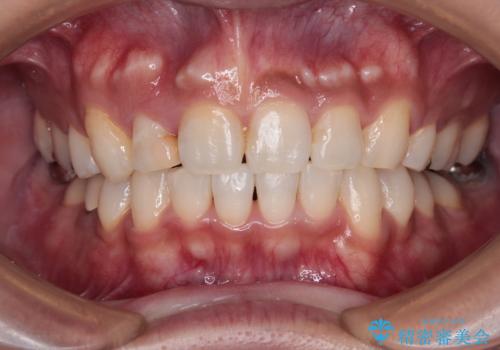 【モニター】八重歯と正中のずれた歯列　片顎抜歯のワイヤー矯正の症例 治療後