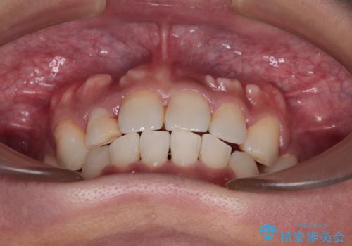 【モニター】八重歯と正中のずれた歯列 片顎抜歯のワイヤー矯正の治療後